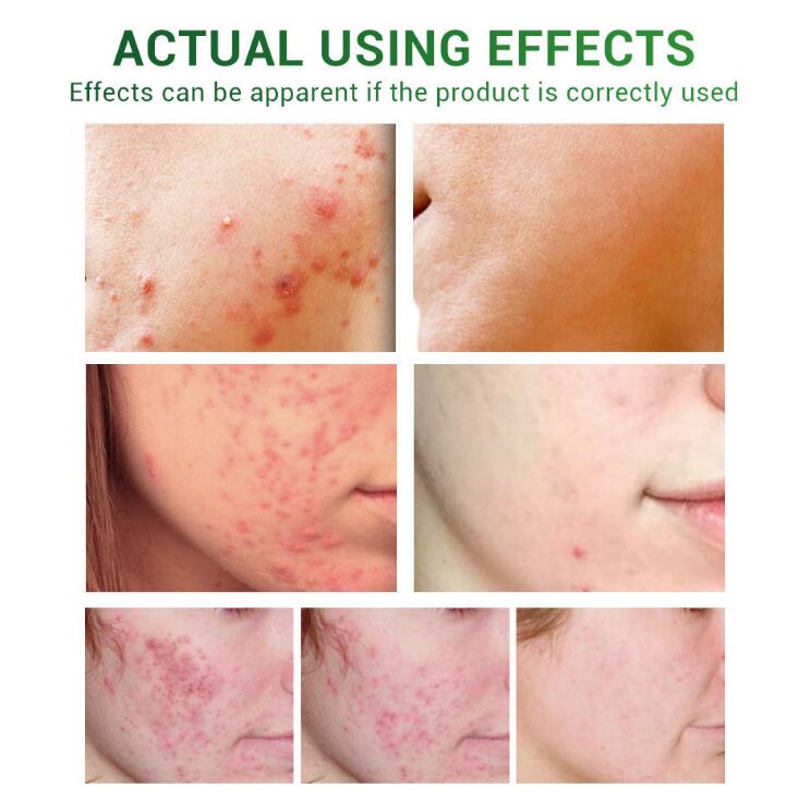 Acne Treatment & Facial Repair Serum