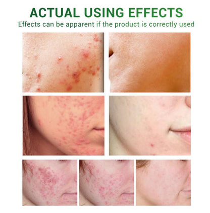 Acne Treatment & Facial Repair Serum